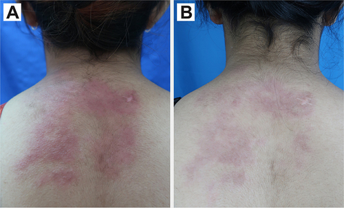 Figure 6 Comparison between skin manifestation on the back before (A) and after four sessions of PDL treatment (B).
