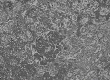 Figure 1. Renal biopsy specimen shows a widespread area of cortical necrosis. Glomerulis shows congestion and thrombosis of capillaries and tubules are necrotic. (Masson's trichrome; original magnification  ×  125)
