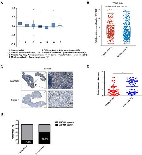 Figure 1 (A) ZNF154 mRNA levels in 305 GC tumor samples and 94 normal controls from the Cancer Genome Atlas (TCGA) data analyzed by ONCOMINE; (B) ZNF154 mRNA levels in GC tumor samples and normal controls from the Cancer Genome Atlas (TCGA) data analyzed by assistant of Clinical Bioinformatics; (C) Representative images of immunohistochemical (IHC) staining of ZNF154 in 70 GC tissues and adjacent normal tissues. The high (upper) and low (lower) expression levels of ZNF154 were evaluated semiquantitatively by the staining intensity; (D and E) Expression differences of ZNF154 in carcinomas and adjacent noncancerous tissues. ****p<0.0001.