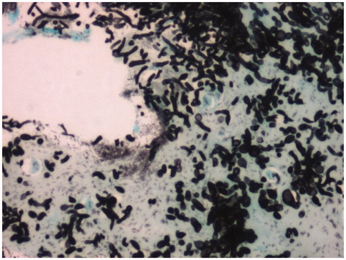 Figure 2. Same specimen showing fungal spores and hyphae with varying morphology [GMS, 200× magnification].