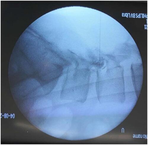 Figure 2 Fluoroscopic image of the lumbar spine in lateral view showing the tip of needle positioned at the upper part of the L4 foramen and dye flowing around the nerve root within the foramen.