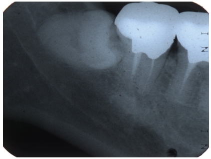 Figure 1 Radiograph of a 58-year-old woman with acute pericoronitis without pericoronal radiolucency below the crown.