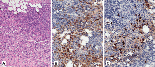 FIGURE 1  (A) Histology of the orbital biopsy showing a dense inflammatory infiltrate and fibrous tissue obliterating the orbital fat (hematoxylin and eosin, ×100). (B, C) The orbital inflammatory infiltrate comprises many IgG-positive plasma cells (B, immunoperoxidase, ×200) of which a minority are positive for IgG4 (C, immunoperoxidase, ×200).