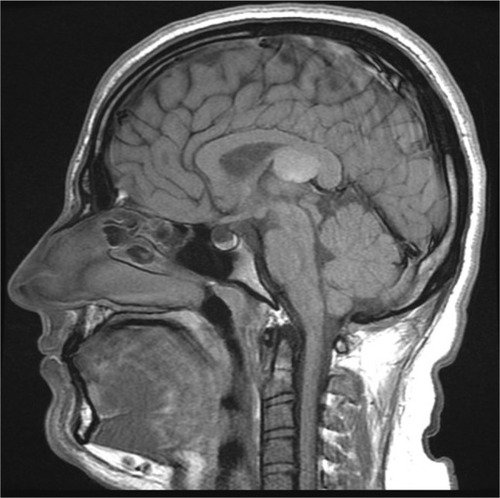 Figure 1 Mid-sagittal T1-weighted image of the brain shows a well-defined, rounded lesion at the roof of posterior third ventricle exhibiting low to intermediate signal intensity relative to the gray matter, with layering at the dependent portion.