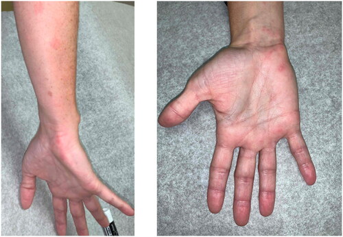 Figure 1. A 42-year-old woman presented with neuropathic pain and Subsequent eruption of vesicular rash in the C8-T1 dermatomal distribution, as pictured.