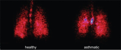 Figure 2 Scintigraphic images of deposition of BDP/F combination in a healthy subject and an asthmatic patient determined by γ-scintigraphy after inhalation of four shots of BDP/formoterol combination labelled with 99 mTc, a γ-emitting isotope (CitationMariotti et al 2007).