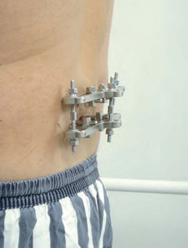 Figure 3:1 The Magerl frame for external spinal fixation.