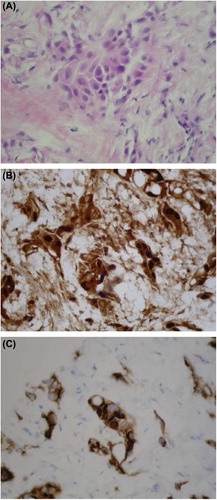 Figure 3. Biopsy of right upper lung nodule demonstrating epithelioid mesothelioma (A) with immunohistochemical staining positive for calretinin (B) and cytoplasmic D2-40 (C) confirming mesothelial origin of biopsied cells.