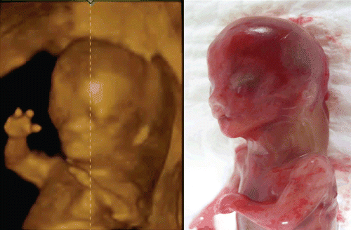 Figure 37.  Left-sided cleft lip seen at 12 weeks of gestation. Left; 3D reconstructed images of bilateral cleft lip seen in cases of trisomy 21. Right; Macroscopic picture of aborted fetus.