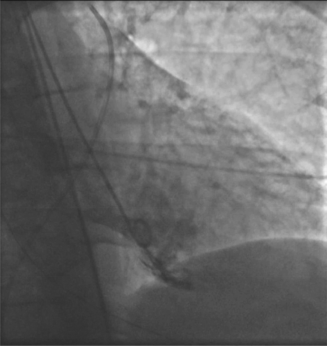 Figure 2. Left Ventriculogram showing apical ballooning.