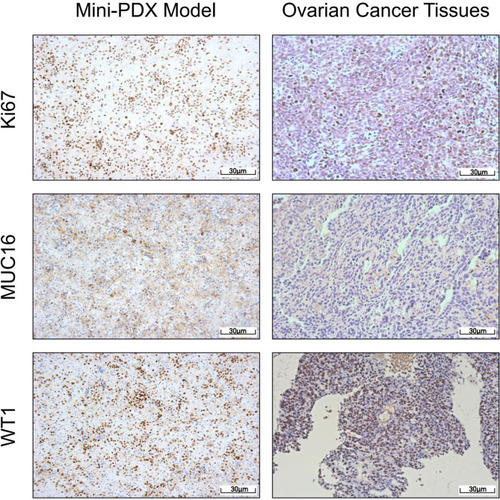 Figure 2 Mini-PDX models demonstrated that the expression levels of IHC markers were consistent with epithelial ovarian cancer tissues (pKi67, MUC16, and WT1 positive).