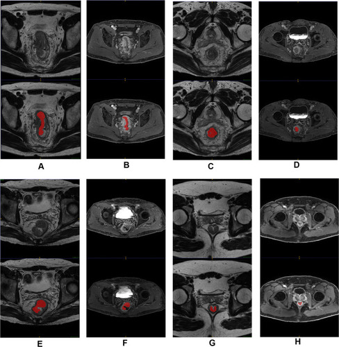 Figure 2 Pretreatment MRI and ROI of four male patients with rectal cancer at stage of cT4aN2bM0, who was (A and B) TRG 0, (C and D) TRG 1, (E and F) TRG 2 and (G and H) TRG 3 after TME, respectively.