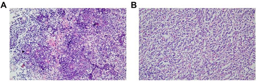 Figure 1 The pathology of patients with PENL. (A) The pathology of DLBCL (primary site from central nervous system). (B) The pathology of mucosa-associated lymphoid tissue lymphoma (primary site from stomach) magnification ×200.