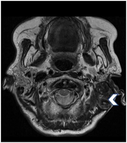 Figure 4. A T2 weighted MRI Image prior to the radiotherapy shows a hypointense soft tissue lesion occupying the left mastoid bowl (arrow head) and middle ear cavity.