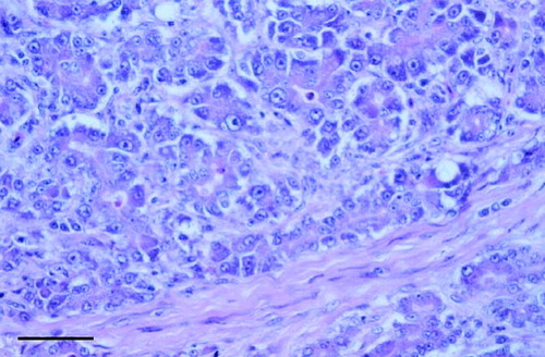 Fig. 3 Close up of Figure 2. Note disorganized, misshapen cells, marked variation in nuclei size, cytoplasmic vacuoles, and interacinar fibrosis. Scale bar=40 μm.