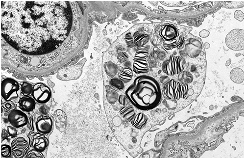 Figure 5 Electron microscopy shows lipid inclusions within podocyte cell bodies with the characteristic appearance of “zebra bodies” and “myelin figures” (x9300 magnification).