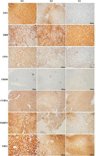 Figure 4 Representative immunohistochemical staining for seven candidate proteins (ASS1, CPS1, UROD, HBB, CYB5A, YBX1, and FKBP11) among well- (G1), moderate- (G2), and poorly (G3) differentiated hepatocellular carcinoma (HCC) tissues. The original scale bar is 500 μm.