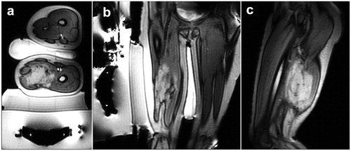 Figure 1. Positioning of patient 1 is shown via axial (a), coronal (b), and sagittal (c) view. These localizer images additionally show the transducer, gel pad, and cooling water bag.