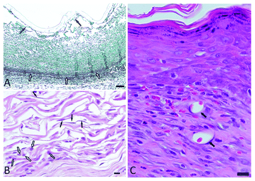Figure 2. (A) Masson’s trichrome stained section demonstrating the intact silicone epidermal layer with a mean thickness of 1.37 ± 0.22 mm (solid arrows) and the integrated scaffold with the interface between the wound bed and scaffold (open arrows). The separation, as seen in the micrograph, was the result of shear forces during sectioning (scale bar = 1000 μm). (B) H&E stained section of the control scaffold on day 7 in vivo. The bottom left quadrant shows large numbers of lymphocytes (open arrows). The middle of the filed as well as the top left indicates fibroblast infiltration (solid arrows) (scale bar = 300 μm). (C) H&E stained section on day 28 in vivo with a superficial layer of the epidermis after healing, neo-collagenesis in the deeper lying areas, and neovascularization (solid arrows) (scale bar = 300 μm).