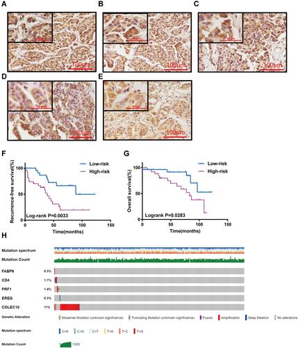 Figure 5 Validation of the TME-related prognostic signature in the 55 liver cancer samples by immunohistochemistry and the alteration analysis of the five genes in cBioPortal database. Representative immunohistochemistry staining for FABP6 (A),CD4 (B),PRF1 (C),EREG (D) and COLEC10 (E). (F) K-M curves of RFS of low- and high- risk groups. (G) K-M curves of OS of low- and high- risk groups. (H) Mutation landscape of the five genes in cBioPortal database.