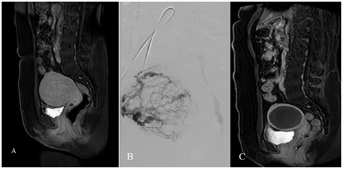 Figure 4. (A) Presents fibroid prior to UFE. The left uterine artery was not embolized due to small calibre. (B) Presents almost complete fibroid vascularization from the right uterine artery. (C) Presents control contrast enhancing MRI with complete fibroid infarction despite the left uterine artery was not embolized.