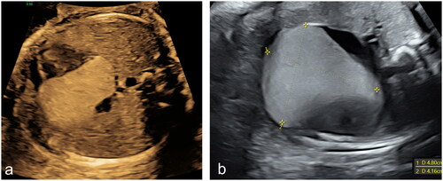 Figure 2. Echocardiographic appearance of the rhabdomyoma at 25 (a) and 37 (b) weeks of gestational age respectively, demonstrating its progressive enlargement.