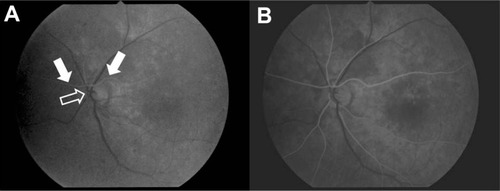 Figure 3 Left fundus fluorescein angiography one month after the initial visit demonstrated an earlier dye appearance in the upper retinal artery (arrow) than in the lower retinal artery (framed arrow) at 11.9 seconds (A) and 12.3 seconds (B) after injection.