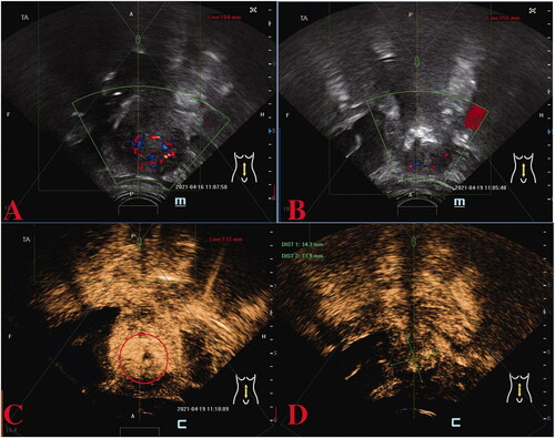 Figure 5. Preoperative and post-operative ultrasound assessment of HIFU therapy in the second case. Preoperative ultrasound localization: abnormal echogenicity on the left side of the uterine fundus with punctate blood flow signal detected (A). Immediate post-operative image with reduced blood supply in the epicenter of the lesion (B); the CEUS image before (C) and after (D) HIFU therapy revealing that the non-perfusion region has filled the treatment area of the lesion. CEUS, contrast-enhanced ultrasound; HIFU, high-intensity focused ultrasound.