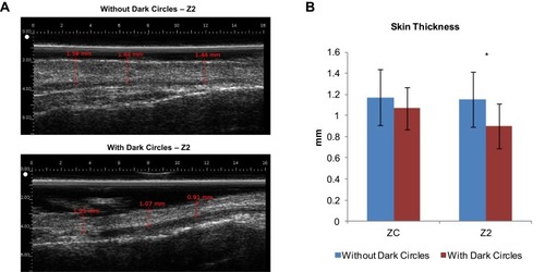 Figure 4 Ultrasound analysis; (A) Example ultrasound images from subjects with and without dark circles. The red lines indicate epidermal/dermal thickness measurements. (B) Average skin thickness measurements across both populations. (N =12 with dark circles versus N=12 without dark circles, *p<0.05).