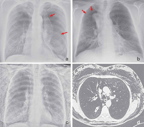 Figure 8. (a): Pneumothorax 1 day after treatment with endobronchial valves in the left upper lobe (indicated by arrows). There is a mediastinal shift to the right, indicating volume expansion due to the pneumothorax. This patient was treated with a chest tube only. (b): Pneumothorax ex vacuo (indicated by arrows) 1 day after treatment with endobronchial valves in the right upper lobe, the pneumothorax resolved spontaneously. Note: there is still volume loss on the site of the pneumothorax. (c and d): Extensive subcutaneous emphysema and pneumomediastinum due to a large air leak after treatment of the left lower lobe. This patient was successfully treated with surgical bullectomy to treat the air leak
