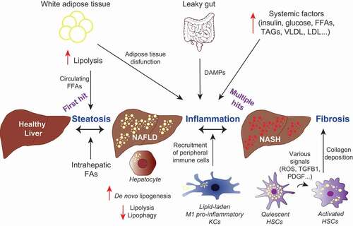 Figure 3. Dysregulated lipid metabolism plays a role in the development of NASH. Altered lipophagy, lipolysis and de novo lipogenesis in the liver contribute to NASH development through fat accumulation, and subsequent inflammation and fibrosis. A “first hit” of increased FFAs leads to accumulation of LDs in hepatocytes, a condition known as NAFLD. Additional “hits”, including inflammation and insulin resistance contribute to steatohepatitis (NASH), characterized by hepatocyte ballooning, lobular inflammation and fibrosis. Liver-resident macrophages (KCs) may acquire a pro-inflammatory phenotype due to the excess hepatic fat burden and mediate the inflammatory response through the recruitment of immune cells from the periphery. In response to hepatic injury, normally quiescent HSCs become activated by various signals. Enhanced lipophagy of vitamin A-storing LDs provides energy for HSCs activation, leading to hepatic fibrosis through HSCs-mediated collagen deposition.