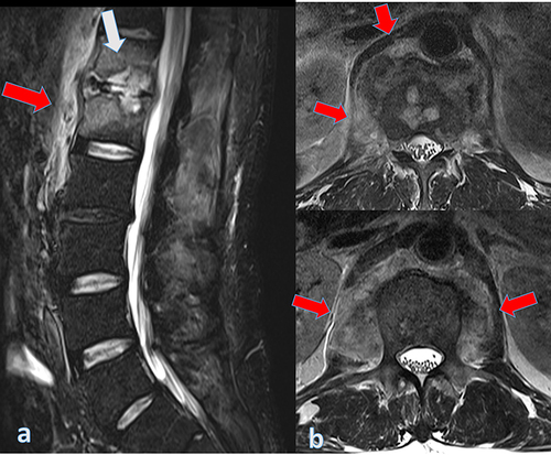 Figure 1 Magnetic resonance imaging of the lumbar spine (pre-treatment) (March 8, 2021). Sagittal STIR (a) and axial T2 (b) images showing bone edema in the vertebral bodies of T12 and L1 associated with irregularity of the vertebral endplate (white arrow) and lateral and anterior paravertebral involvement from T10 to L2 with involvement of the psoas muscles (red arrows).