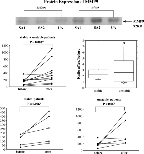 Figure 2.  A representative immunoblot showing protein extracts from human saphenous veins sampled before and after surgical preparation for CABG from patients with stable (SA) or unstable angina (UA). MMP9 protein is illustrated by dot-plots, showing the individual change from the first to the second biopsy for stable (n = 5) and unstable patient groups (n = 6) jointly and separately. The ratio between the second and first value is shown by a box-plot for each group. Protein expression of MMP9 was increased by surgical handling of the veins of all patients. When the patients were subdivided into groups according to plaque stability, an increase of MMP9 was found after surgical vein graft handling in stable patients, while this difference becomes smaller in veins from unstable patients. In the stable group the log-scale-estimated population factor of increase (ratio After/Before) is 2.2, with a 95% confidence interval of (1.4, 3.4). Note that the scale of relative protein expression on the dot-plots are different.