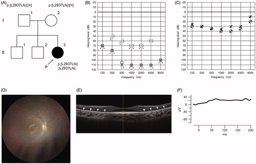 Figure 2. Clinical findings of Case #13. (A) Pedigree and genetic testing results for the proband and family. (B) The audiogram of the proband indicated bilateral profound hearing loss. (C) Hearing thresholds with bilateral cochlear implants were adequate. (D) Fundus examination revealed atrophic peripheral retina and attenuated retinal vessels (E) SD-OCT demonstrated that the thickness of outer retinal layers was decreased. Arrowheads indicate thinned outer retinal layers. (F) Full-field ERG of rod- and cone-mixed maximum response showed non-recordable patterns bilaterally.