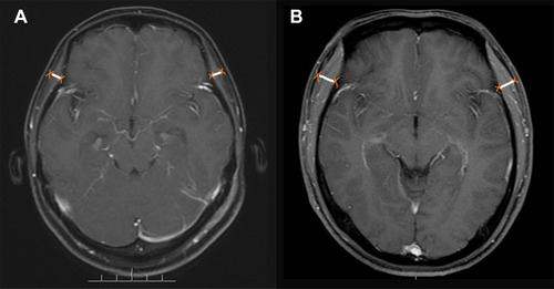 Figure 3 (A) a 40-years-old female patient with a three months overall survival (median TMT=5.00mm), and (B) a 27-years-old male patient with a thirty-four months overall survival (median TMT=10.20mm).