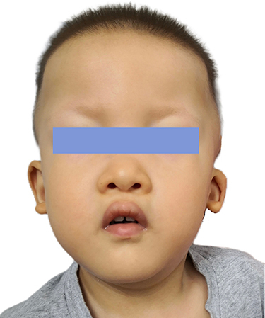 Figure 2 Distinctive facial characteristics of Patient 2 with Mowat-Wilson syndrome. The patient shows characteristic facial features of Mowat-Wilson syndrome, including frontal bossing, rounded nasal tip, sparse eyebrows, prominent chin, widely spaced teeth, and uplifted ear lobes with a central depression.