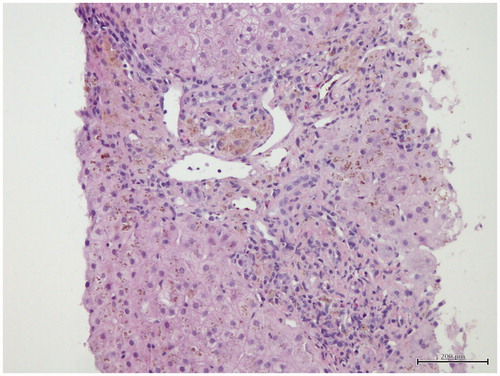 Figure 1. There is hepatocyte iron overload with mild portal inflamation and fibrosis (H&E ×200).