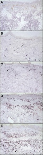 Figure 1 Representative photomicrographs of skin biopsies submitted for Southwestern histochemistry for detection of activated NFκB (original magnification 200×).Notes: Arrows demonstrate purple nuclear staining. Detection was quantified by an NFκB activation index, which values ranged from zero to four. (A) NFκB activation index of 0: no nuclear staining (negative control); (B) NFκB activation index of 1: up to 10% nuclear staining in sparse lymphocytes from a tuberculoid lesion; (C) NFκB activation index of 2: 11%–25% nuclear staining in cells from a superficial lymphohistiocytic infiltrate and fibroblasts (arrows) from a borderline tuberculoid lesion; (D) NFκB activation index of 3: 26%–50% nuclear staining in cells from a perivascular and perineural inflammatory infiltrate, involving the superficial and mid dermis. There was staining of histiocytes, lymphocytes, fibroblasts, and vascular endothelium (arrow tip) from a lepromatous lesion; (E) NFκB activation index of 4: >50% nuclear staining in cells from a dense perineural and perivascular inflammatory infiltrate. There was staining of fibroblasts, histiocytes, and lymphocytes from a borderline lesion.Abbreviation: NFκB, nuclear factor kappa B.