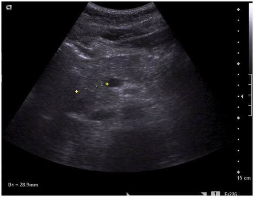 Figure 2b. Abdominal ultrasound: axial image showing the hypoechogenic pancreatic head. The transverse diameter of the pancreatic head is 2.89 cm.