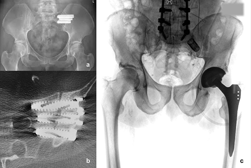 Figure 1 (a) Triangular plasma spray-coated titanium bolt implants with a porous surface, (b) cannulated bone screws with large diameters or (c) hollow screws as distraction interference arthrodesis are used for SIJ fusion.