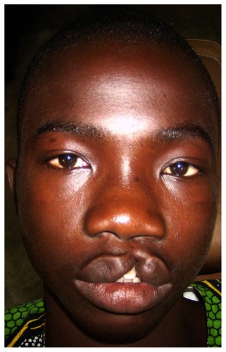 Figure 2 A 12-year-old boy with an incomplete cleft of the lip.