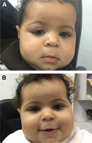Figure 1 Infant, 6 months of age, with right-eye hemangioma.