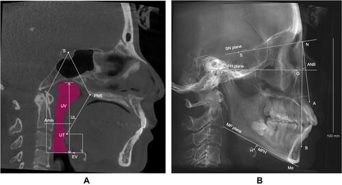Figure 2 Measurements of the upper airway morphology and hyoid bone position. (A) Airway measurements in the median sagittal plane. (B) Reconstructed lateral cephalogram.
