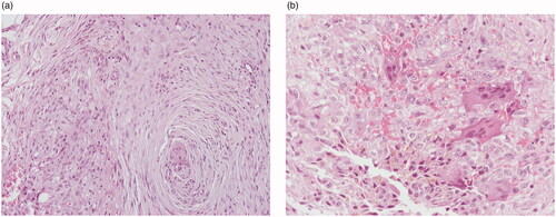 Figure 2. Histologic features: elongated neoplastic cells arranged in interconnected fascicles with a plexiform pattern (A). Ovoid and round neoplastic cells intermixed with osteoclast-like giant cells and hemosiderin deposition (B). (A: hematoxylin-eosin, ×100, B: hematoxylin-eosin, ×200)