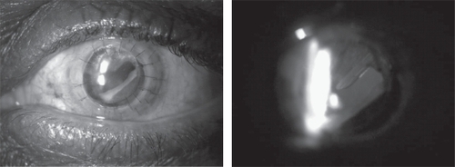 Figure 2 Slit lamp photographs of the left eye taken two months postoperatively. (A) Clear corneal graft with optic capture of a MA60AC (Alcon, Fort Worth, TX) intraocular lens. (B) The tip of the Ahmed tube in the anterior vitreous cavity is not occluded, as visualized by retroillumination.