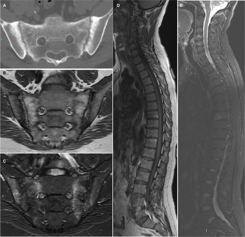 Figure 2 Forty two year old male with ankylosing spondylitis.Notes: Axial CT image of the SIJs (A) demonstrating advanced disease with bilateral subchondral sclerosis, erosions, and pseudo-widening of the joints. Whole-spine MRI of the same patient with semicoronal T1-weighted (B), STIR (C) of the SIJs, and sagittal T1-weighted (D) and STIR (E) of the entire spine demonstrating bilateral SIJ’s BME, fat metaplasia, and erosions as well as corner inflammatory lesions and fatty lesions in the spine.Abbreviations: BME, bone marrow edema; CT, computed tomography; MRI, magnetic resonance imaging; SIJ, sacroiliac joint; STIR, Short-TI inversion recovery.