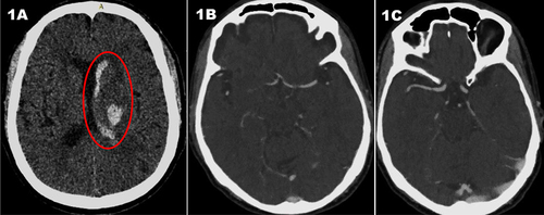 Figure 1 (A) Axial non-contrast-enhanced Head CT illustrates the characteristics of acute hemorrhage. The red circle indicates left thalamic high-density collection with intraventricular extension. (B) Axial Cerebral CT angiography (CTA) showing normal left middle cerebral artery (MCA) with no vascular malformation, aneurysm or stenosis. (C) Axial cerebral CTA at the level of right MCA reveals no vascular abnormalities.