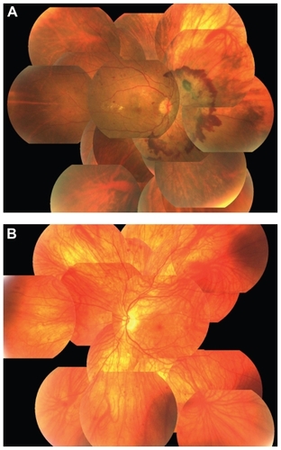 Figure 2 Panoramic fundus photograph. (A) Huge neovascularization can be seen on the optic disc in the right eye. Hypopigmentation of the retinal area exists at upper peripheral region. (B) The entire retina is hypopigmented in the left eye. Major choroidal vessels can be seen throughout the retina. Neovascularization is not apparent in this eye.