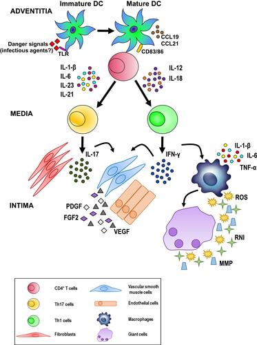 Figure 8 Possible pathogenetic algorithm of giant cell arteritis (GCA). After activation by danger signals, dendritic cells resident in the arterial adventitia mature, produce chemokines such as CCL19 and CCL21, and express the co-stimulatory molecules CD83 and CD86 required for their interaction with CD4+ T cells. Dendritic cells also release cytokines, such as IL-1 β, IL-6, IL-23 and IL-21 or IL-12 and IL-18 that trigger two distinct networks. The first network induces the differentiation of activated T cells into Th17 cells; the second drives Th1 cell formation. Both T cell lineages participate in the evolving granulomatous inflammation. See text for details.