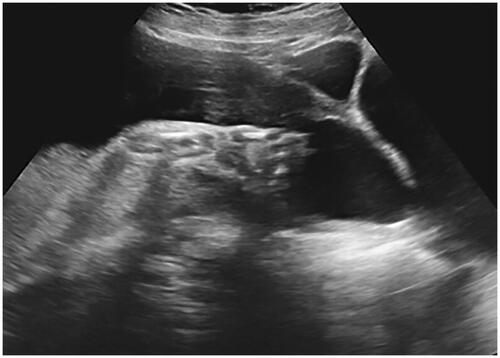 Figure 2. An anechoic area in the lower uterine segment at the area of the caesarean section scar.